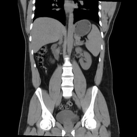 What Is Epiploic Appendagitis How Is It Treated