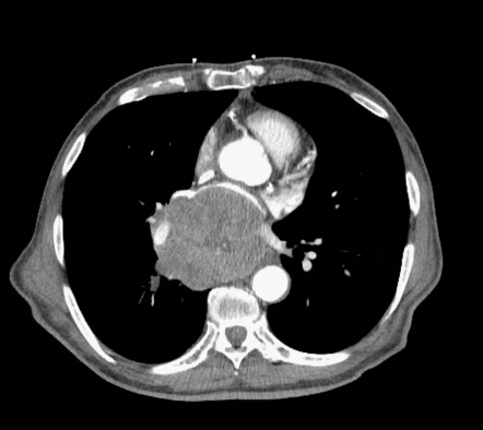 Small cell lung cancer invading the left atrium | Radiology Case ...