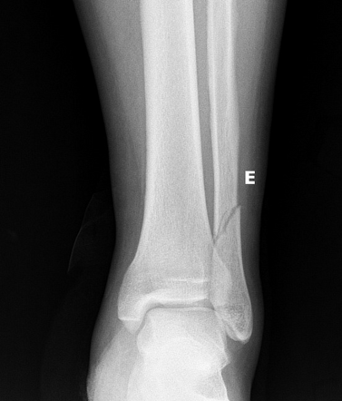 icd 10 code for right weber b lateral malleolus fracture