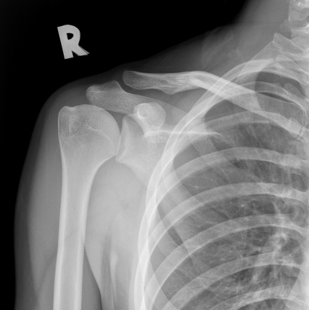 Normal shoulder radiograph | Radiology Case | Radiopaedia.org