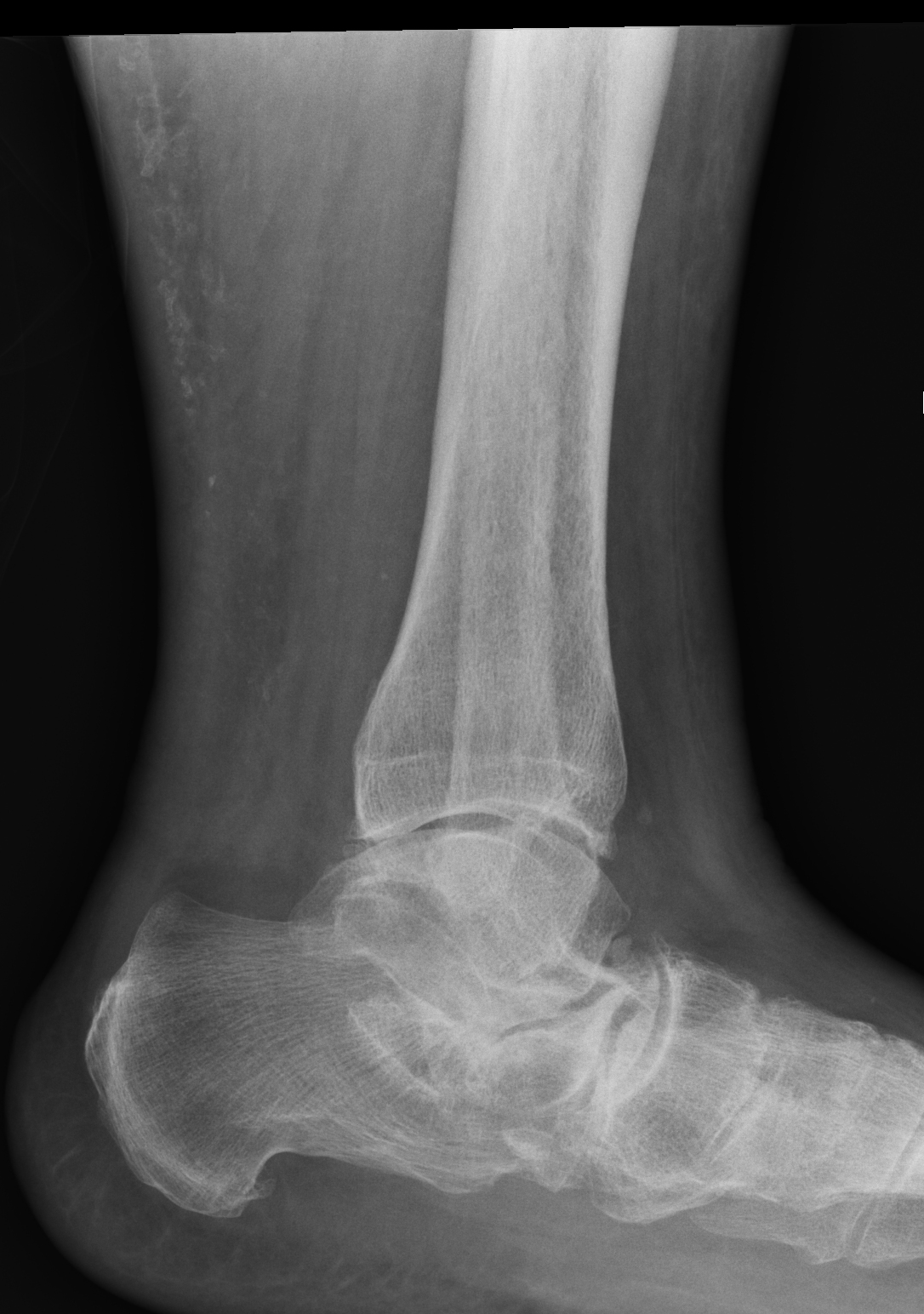 Extra-articular talocalcaneal impingement | Image | Radiopaedia.org