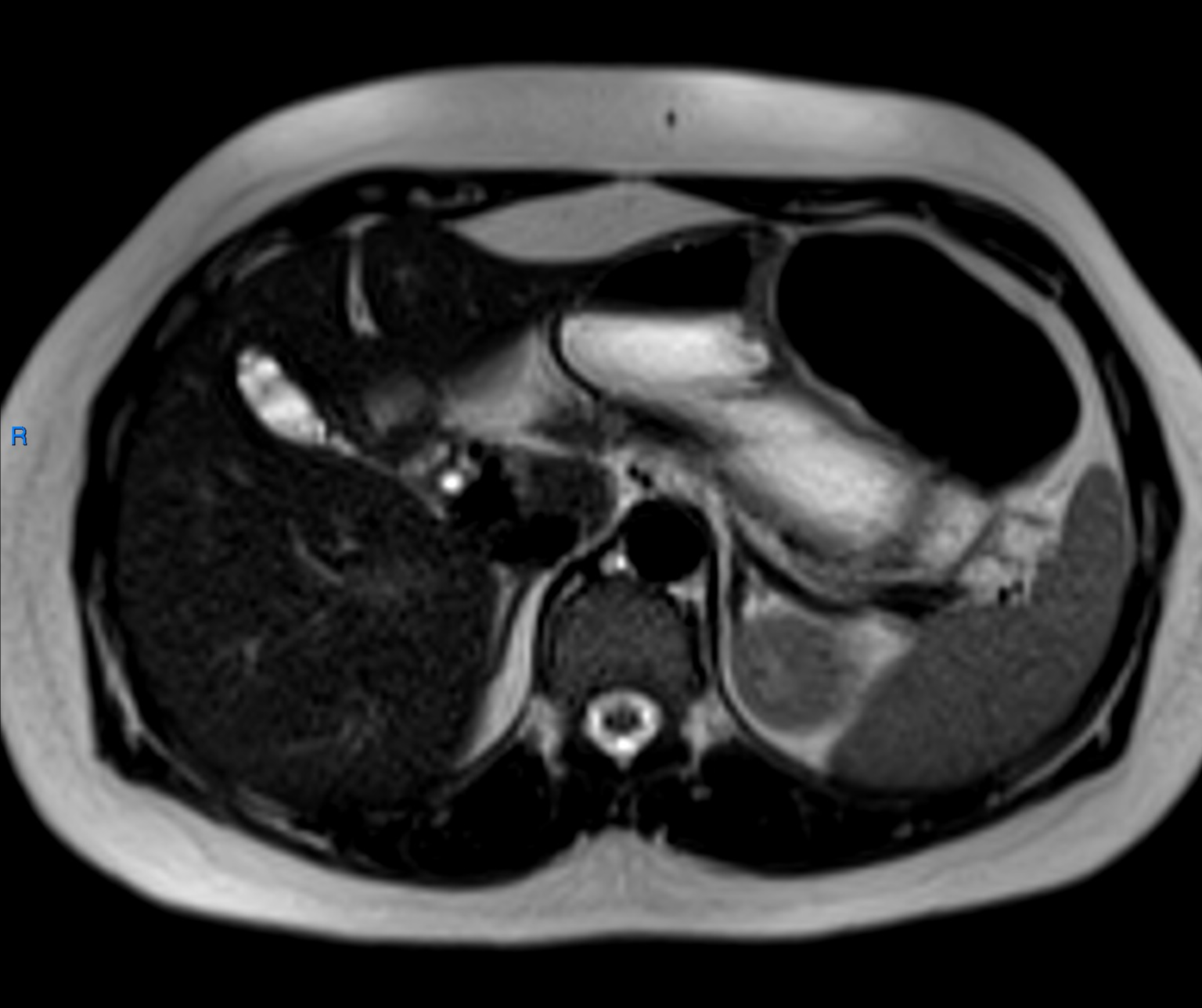 Septate gallbladder | Image | Radiopaedia.org