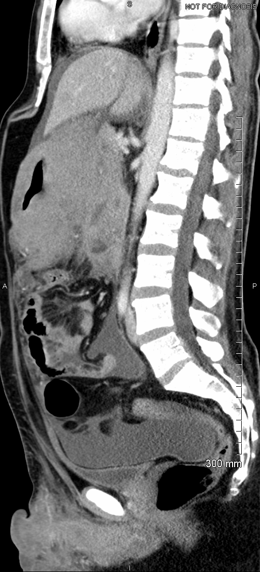 Gastric Lymphoma Image 2346