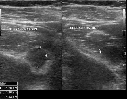 Paralabral Cyst Of The Shoulder Radiology Reference Article Radiopaedia Org