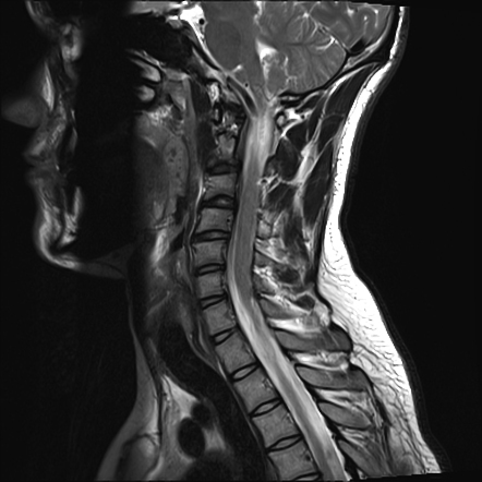 Brachial plexus injury with pseudomeningoceles | Radiology Case ...