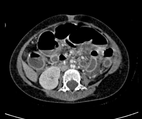 Enterocolic fistula - huge | Image | Radiopaedia.org