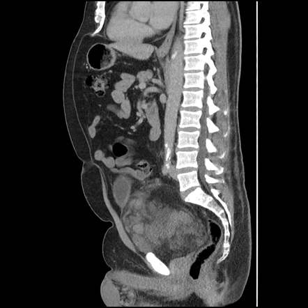 Retroperitoneal liposarcoma | Radiology Case | Radiopaedia.org