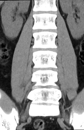 Lumbar discal cyst | Image | Radiopaedia.org