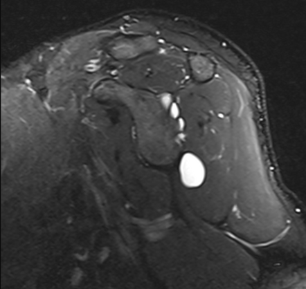 Shoulder paralabral cyst | Image | Radiopaedia.org