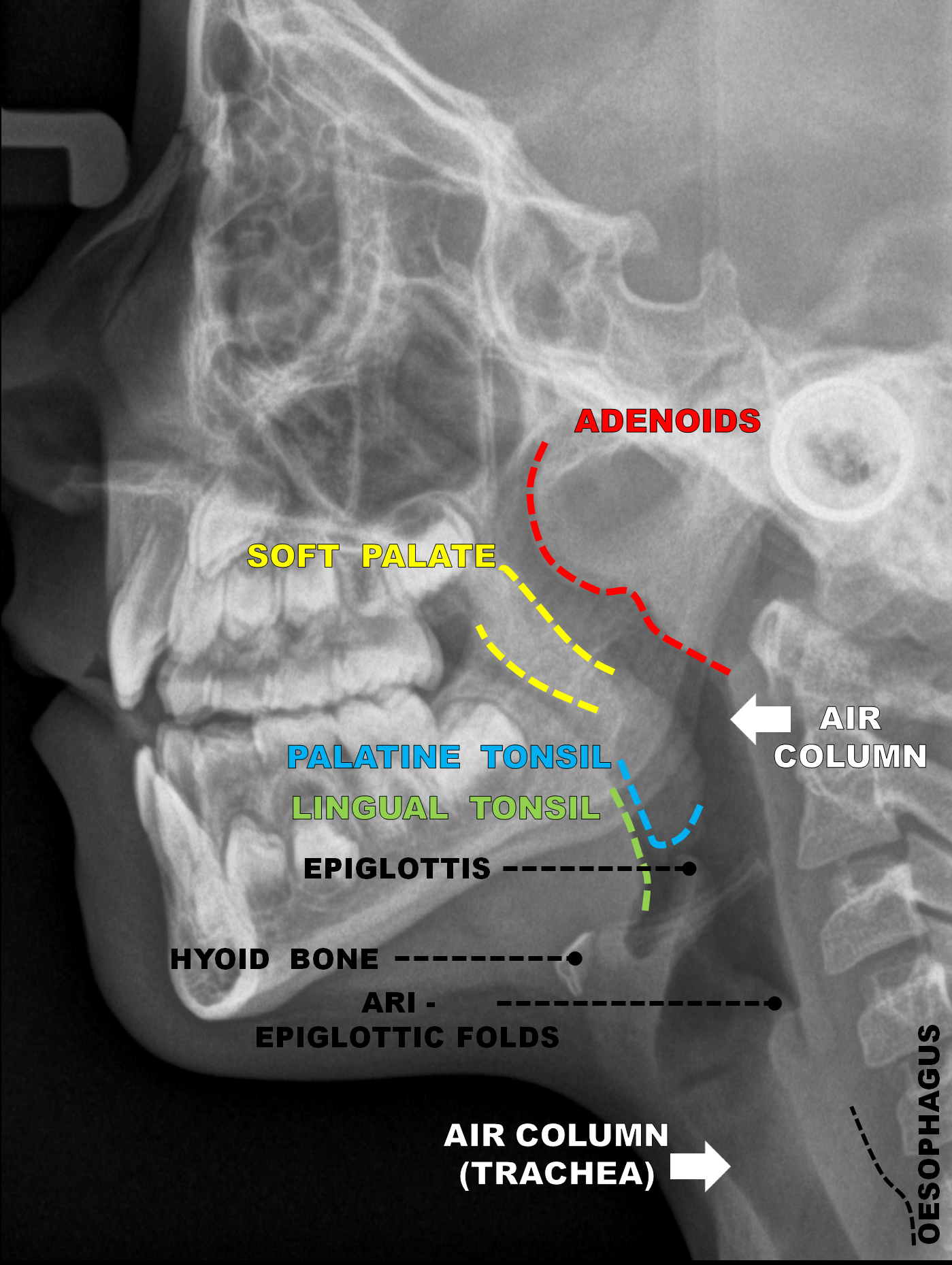 Adenoidal hypertrophy | Image | Radiopaedia.org