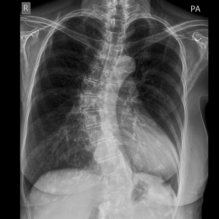 Scoliosis | Radiology Case | Radiopaedia.org