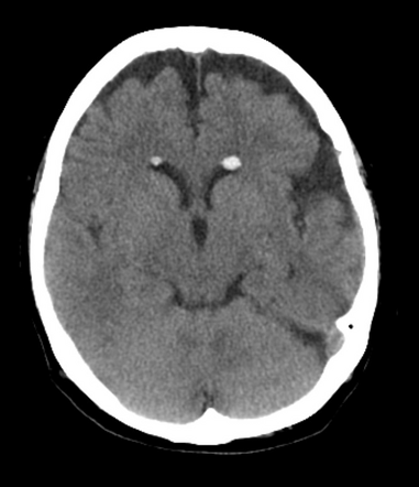 Silicone embolization from intraocular implant | Radiology Case ...