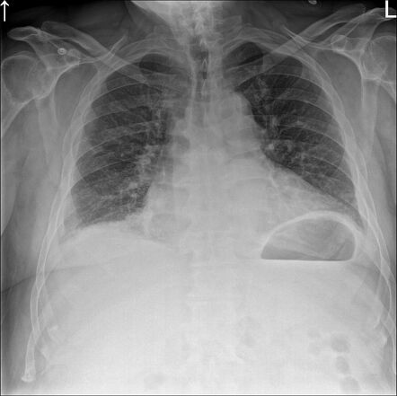 Kidney injury due to fall | Radiology Case | Radiopaedia.org