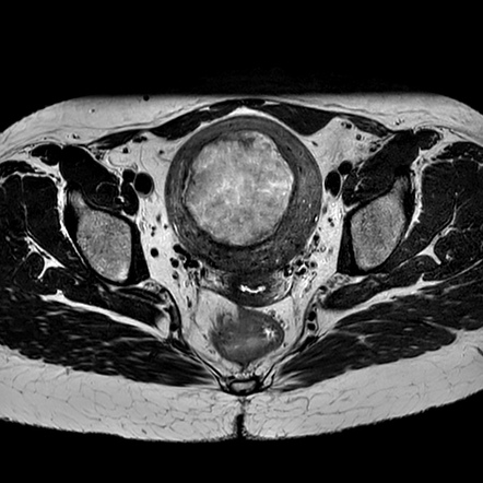 Red degeneration of uterine fibroid | Image | Radiopaedia.org