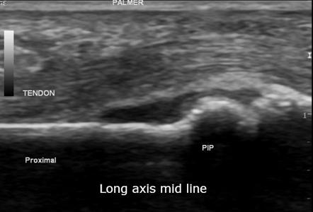 Intra-articular foreign body in proximal interphalangeal joint ...