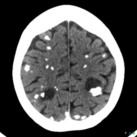 Calcified Cerebral Metastases In Treated Breast Cancer Radiology Case Radiopaedia Org