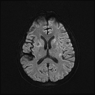 Cerebral Toxoplasmosis 