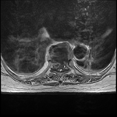 Spondylodiscitis | Image | Radiopaedia.org