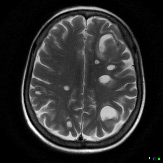 Calcified Cerebral Metastases In Treated Breast Cancer Radiology Case Radiopaedia Org