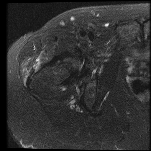 Synovial herniation pit - growing | Image | Radiopaedia.org