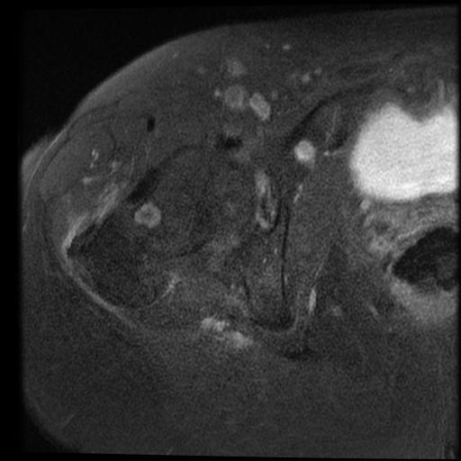 Synovial Herniation Pit - Growing 