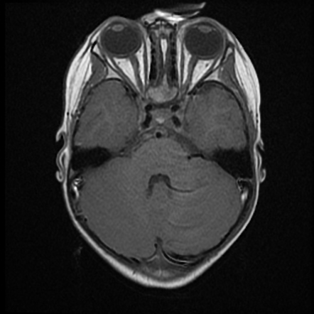 Fourth branchial cleft cyst and fistula | Radiology Case | Radiopaedia.org