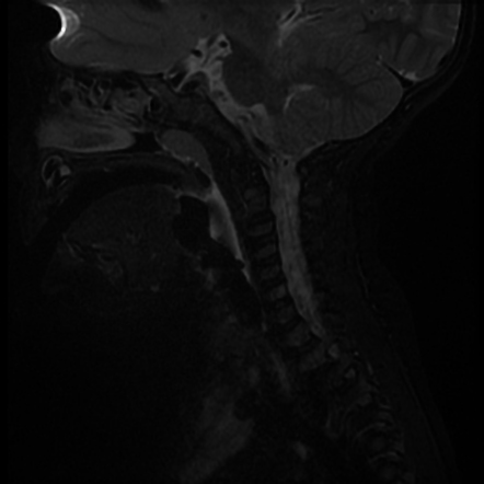 Fourth branchial cleft cyst and fistula | Image | Radiopaedia.org