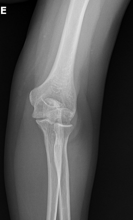 Capitellum fracture | Image | Radiopaedia.org