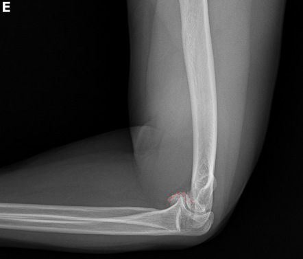 Double-arc sign | Radiology Reference Article | Radiopaedia.org