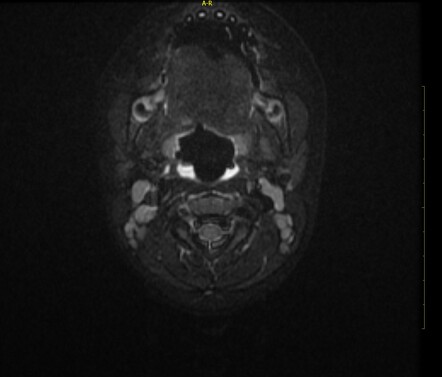 Fourth branchial cleft cyst and fistula | Image | Radiopaedia.org