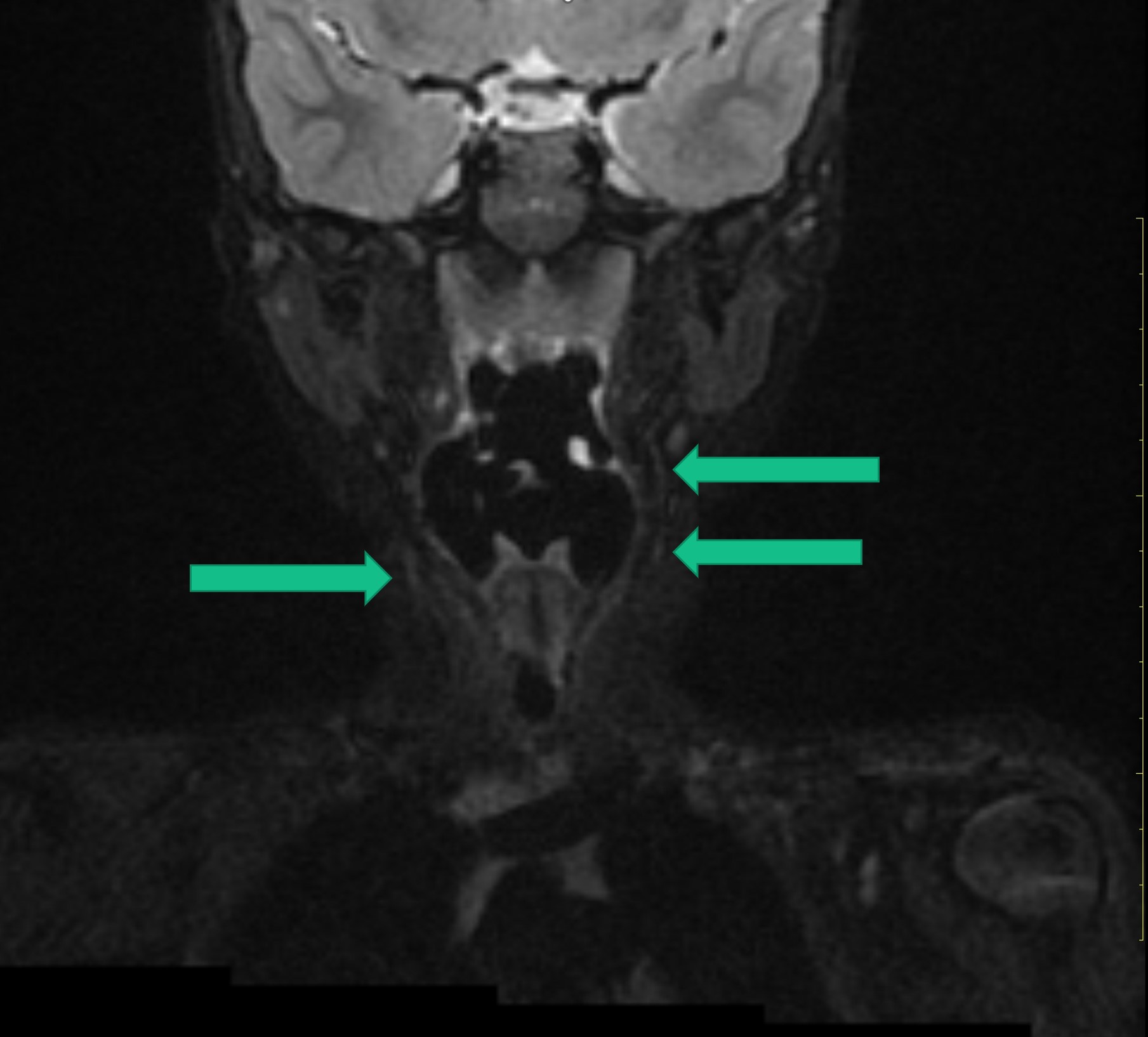 Fourth branchial cleft cyst and fistula | Image | Radiopaedia.org