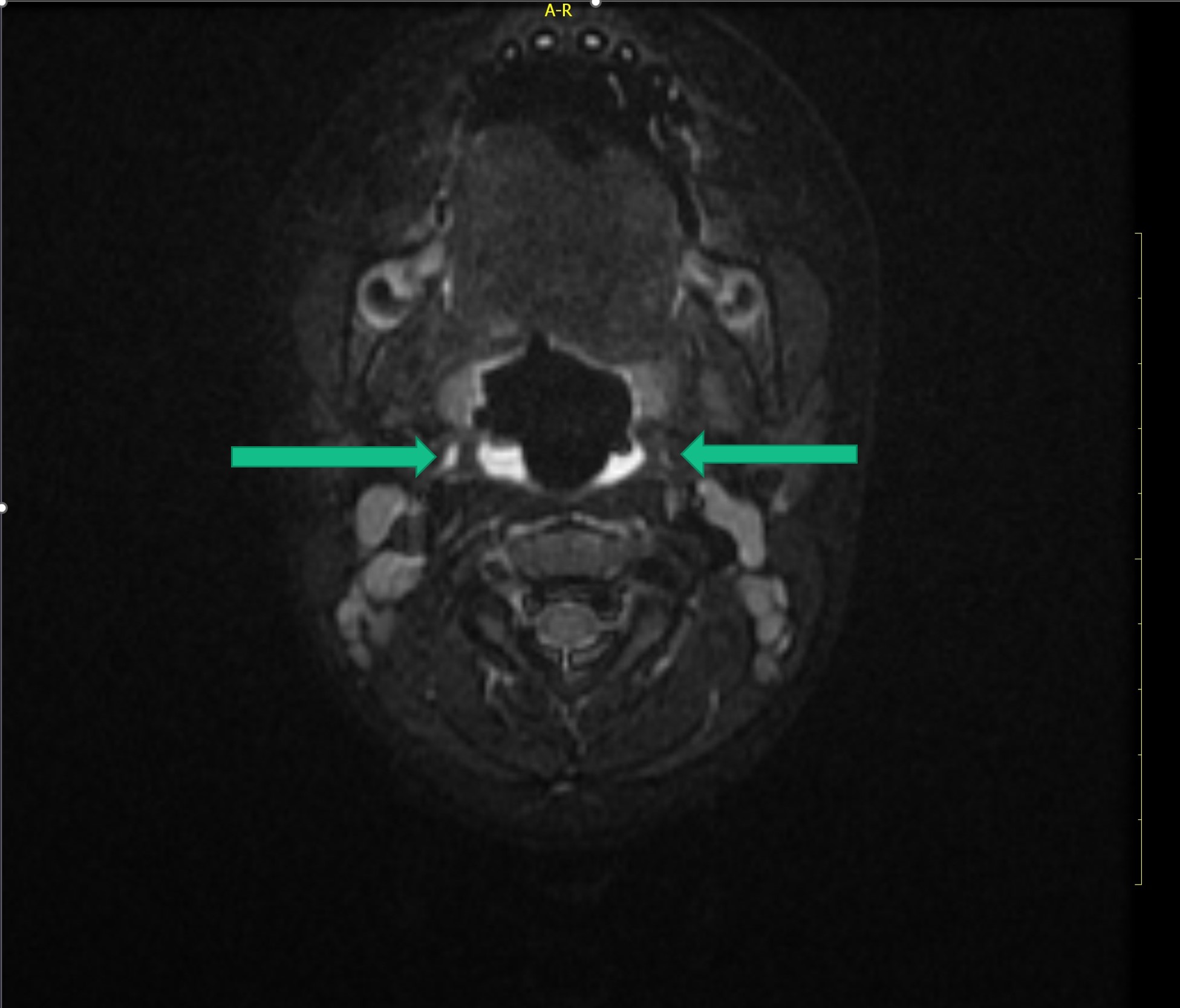 Fourth branchial cleft cyst and fistula | Image | Radiopaedia.org