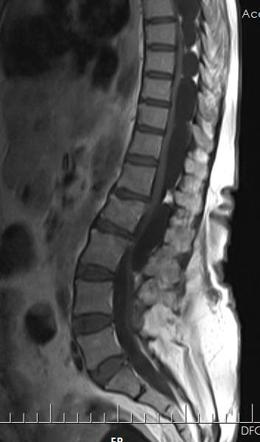 Multiple spinal arachnoid cysts | Radiology Case | Radiopaedia.org