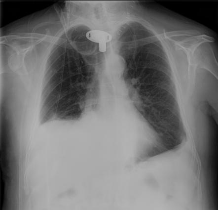 Diaphragmatic Paralysis Radiology Reference Article Radiopaedia Org