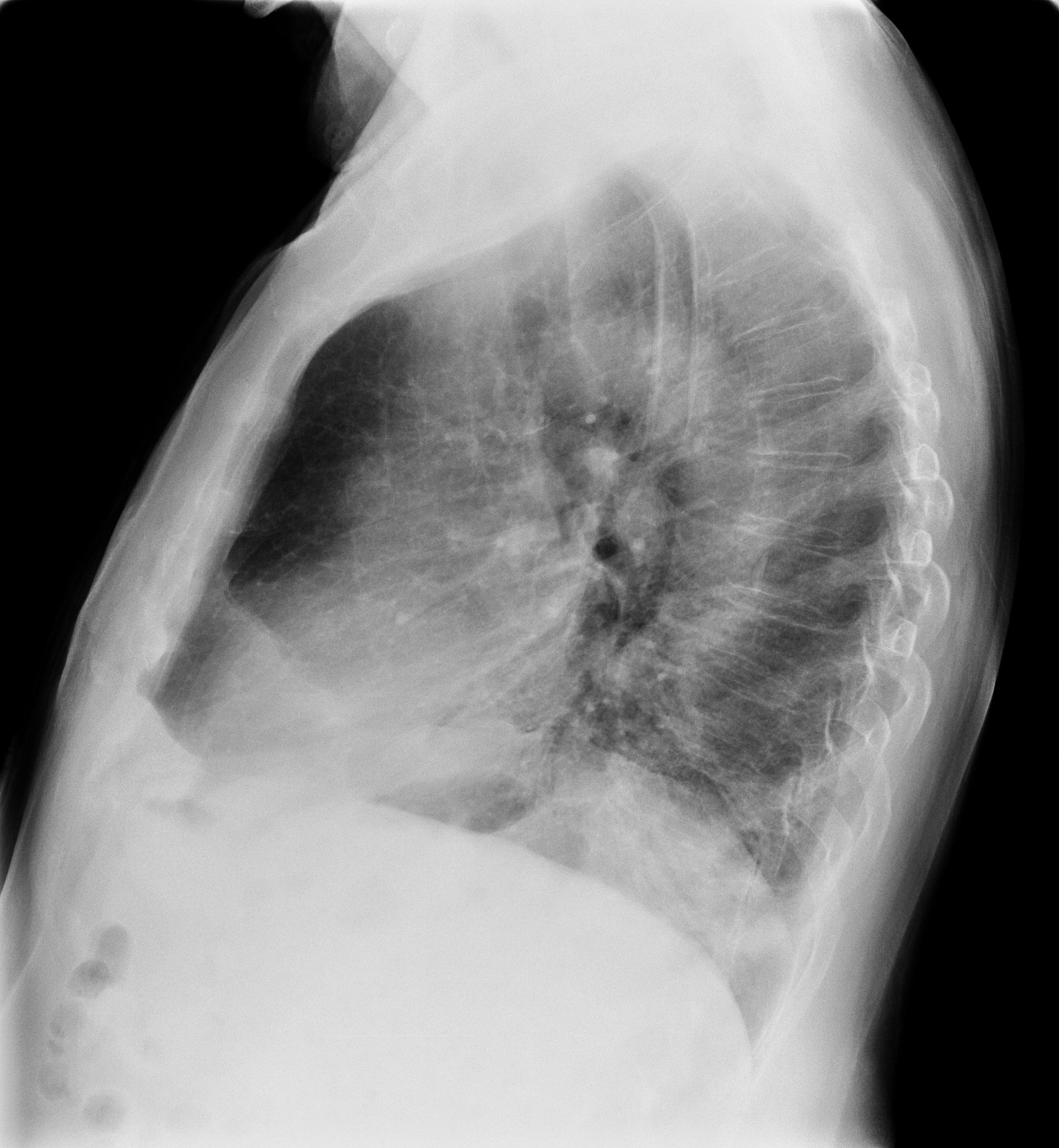 Right Diaphragmatic Paralysis Image Radiopaedia Org