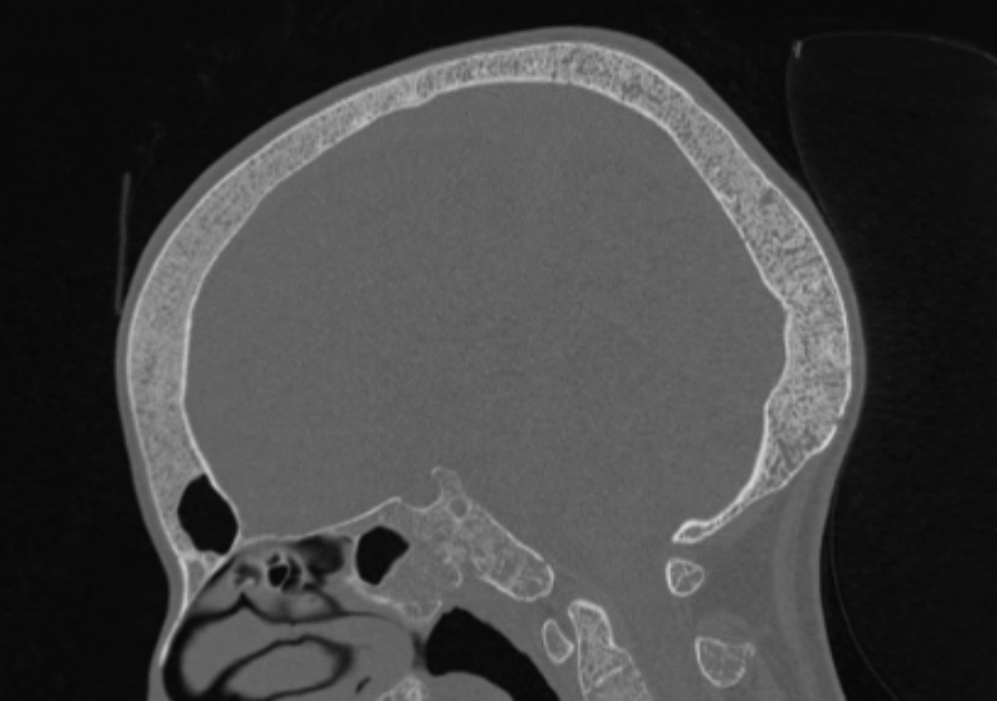 Thalassemia Skull Image 