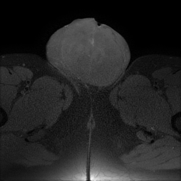 Testicular Malignant Mixed Germ Cell Tumor Image