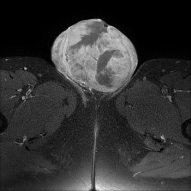 Testicular Malignant Mixed Germ Cell Tumor Image