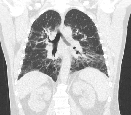 Fibrotic hypersensitivity pneumonitis | Image | Radiopaedia.org