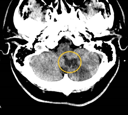 Cerebellar Infarcts | Radiology Case | Radiopaedia.org