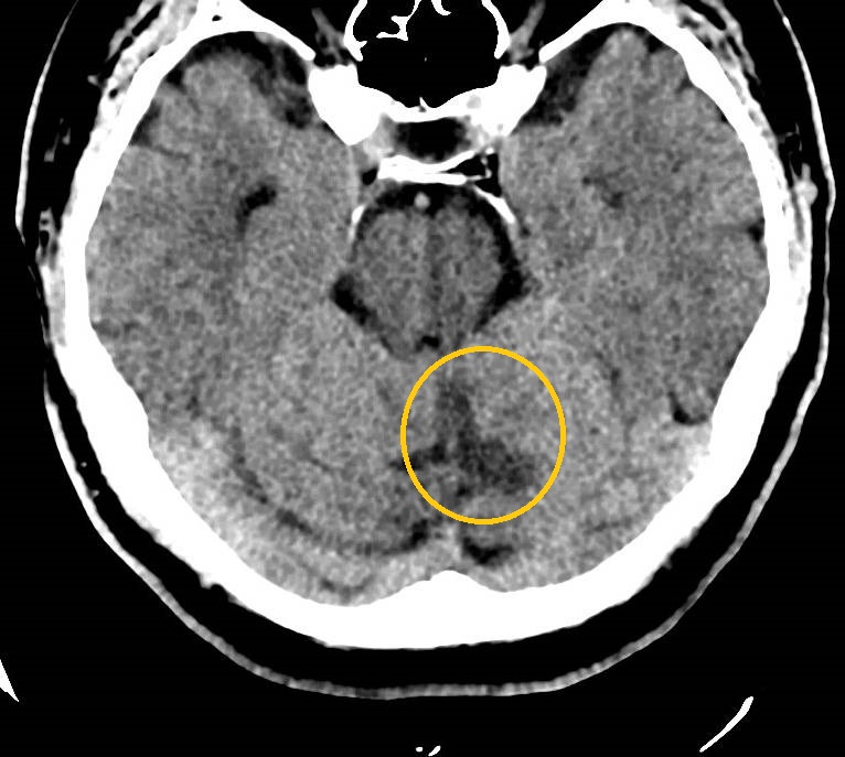 Cerebellar infarcts | Image | Radiopaedia.org