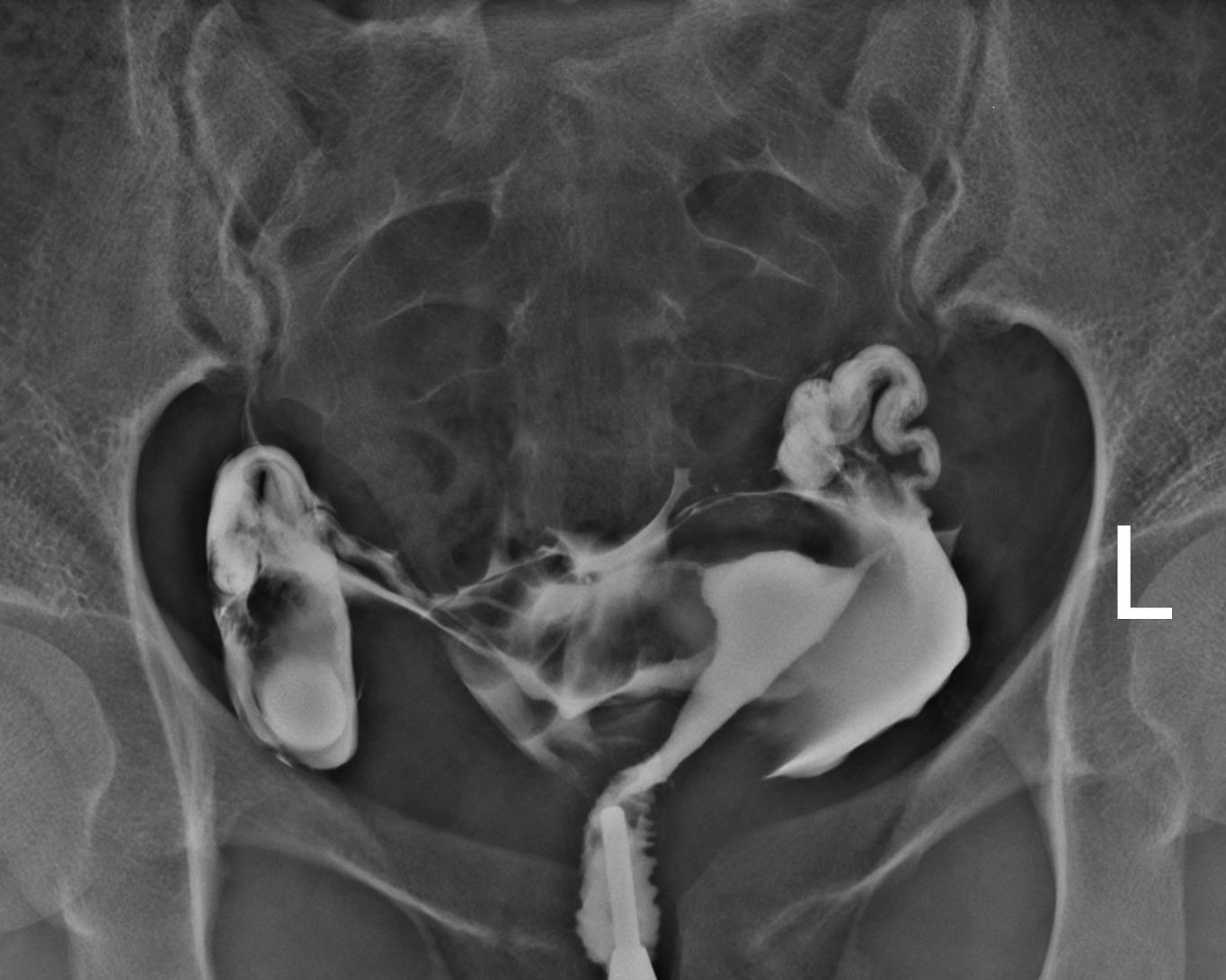 Peritubal adhesions on hysterosalpingogram | Image | Radiopaedia.org