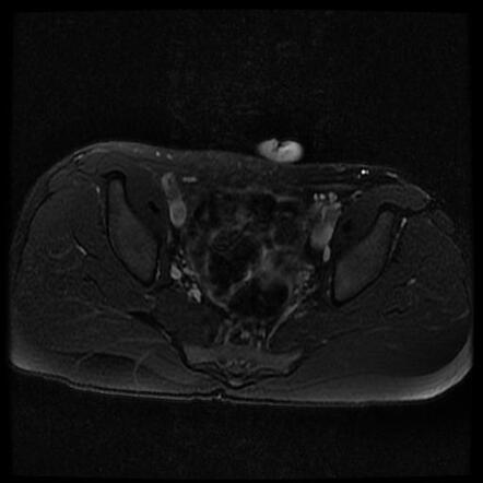 Sacroiliitis - unilateral | Radiology Case | Radiopaedia.org