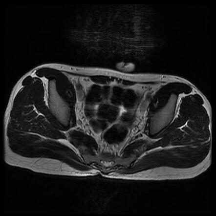 Sacroiliitis - unilateral | Image | Radiopaedia.org