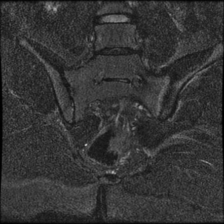 Sacroiliitis - unilateral | Radiology Case | Radiopaedia.org