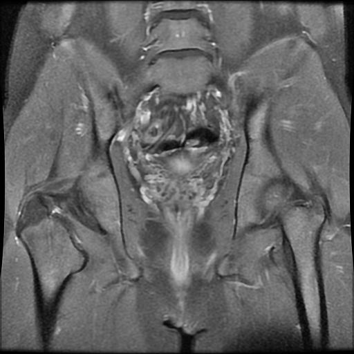 Sacroiliitis - unilateral | Image | Radiopaedia.org