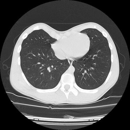 Pectus excavatum | Radiology Case | Radiopaedia.org