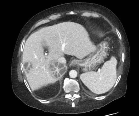 Hepatic abscesses and large splenic abscess | Image | Radiopaedia.org