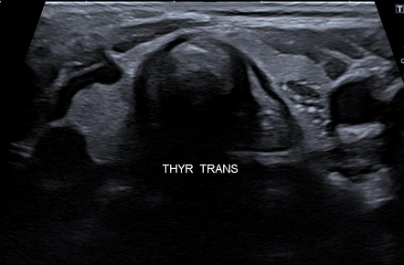 Ectopic thymus - intrathyroidal | Radiology Case | Radiopaedia.org