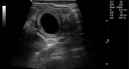 Enteric duplication cyst | Radiology Case | Radiopaedia.org